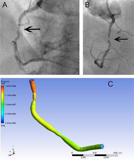 A new, award-winning computer system, which assesses heart disease better than the naked eye, could revolutionise the way patients with conditions such angina and heart attack are assessed and treated - saving lives and money.