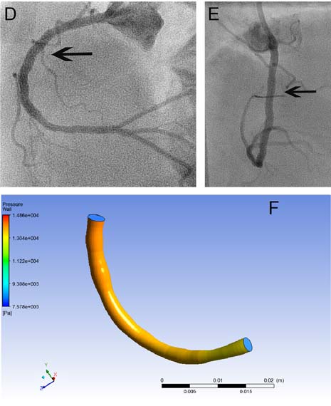 Doctors currently decide how to treat coronary artery disease by looking at X-ray pictures of the arteries (an angiogram). This involves inserting a tube through the wrist or groin and injecting dye into the arteries to find out where, and how severely, the coronary arteries are diseased.