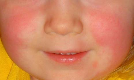 Public health officials from Derbyshire County Council are warning parents to look out for the symptoms of scarlet fever in their children.