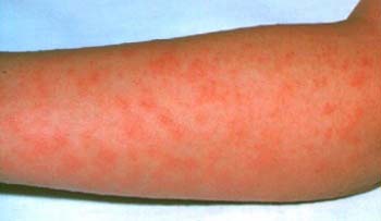 The first symptoms of scarlet fever often include a sore throat, headache, fever, nausea and vomiting. After 12 to 48 hours a fine red rash develops which feels like sandpaper to touch.